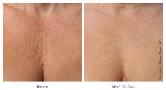 Treating Chest Wrinkles At Any Age With Ultherapy - Radiance